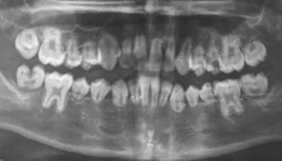 牙根短能做隐形矫正吗?